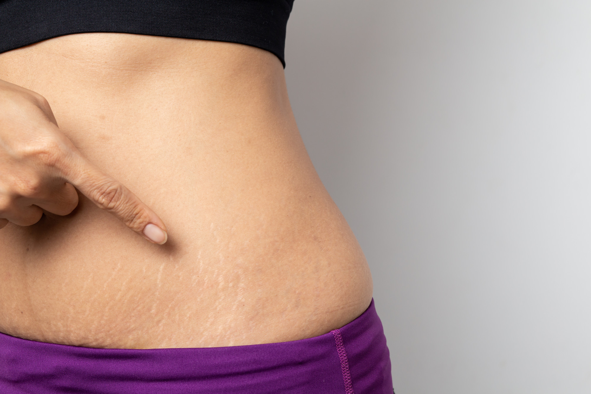 women-show-off-belly-after-birth-stretch-marks-white-background