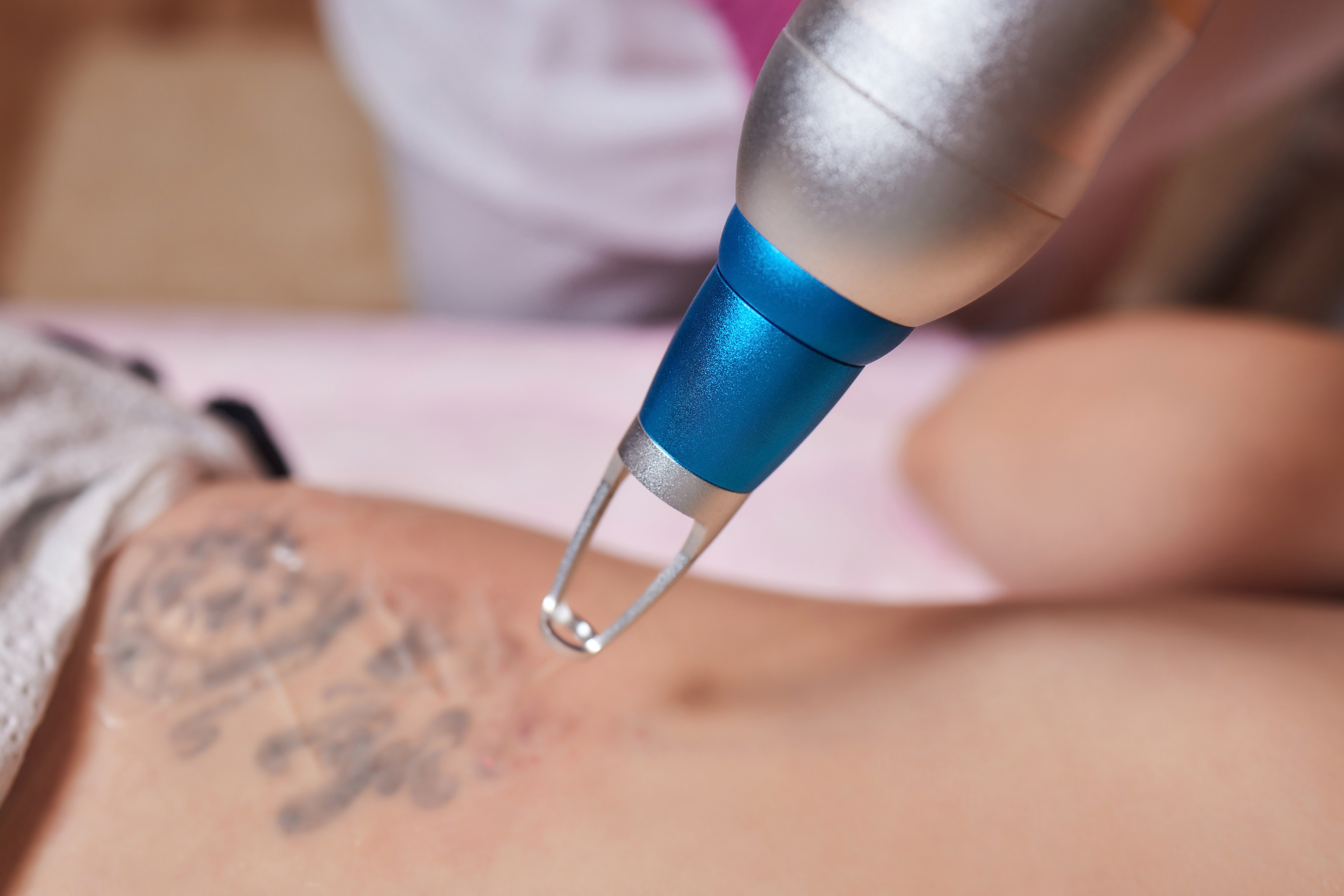Young woman undergoing laser tattoo removal procedure in salon, closeup.
